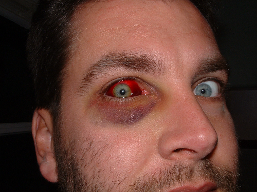 2009-11-10_19:45:56_jons_injured_eye.jpg, 749 KB